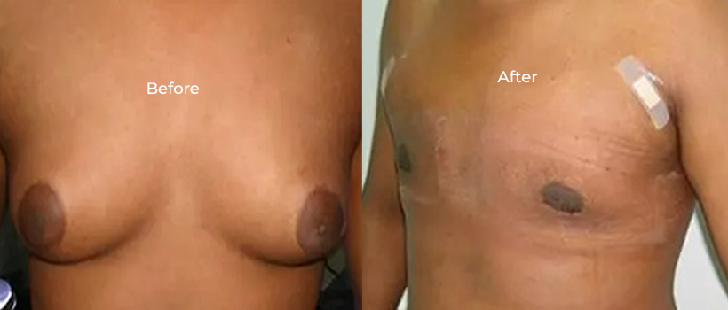 Gynecomastia correction result