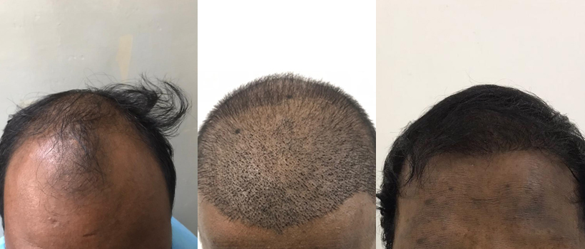 Hair transplantation result