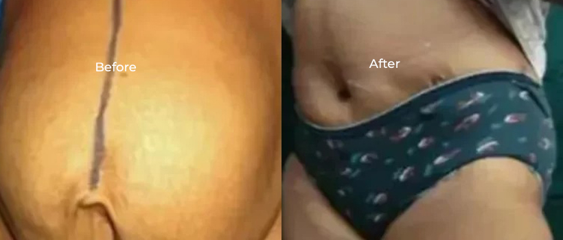 Abdominoplasty treatment illustration