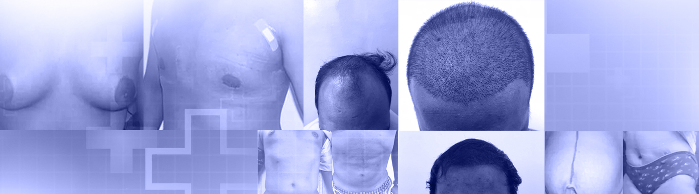 Gynecomastia Surgery & Treatment in Chennai | Male chest Reduction