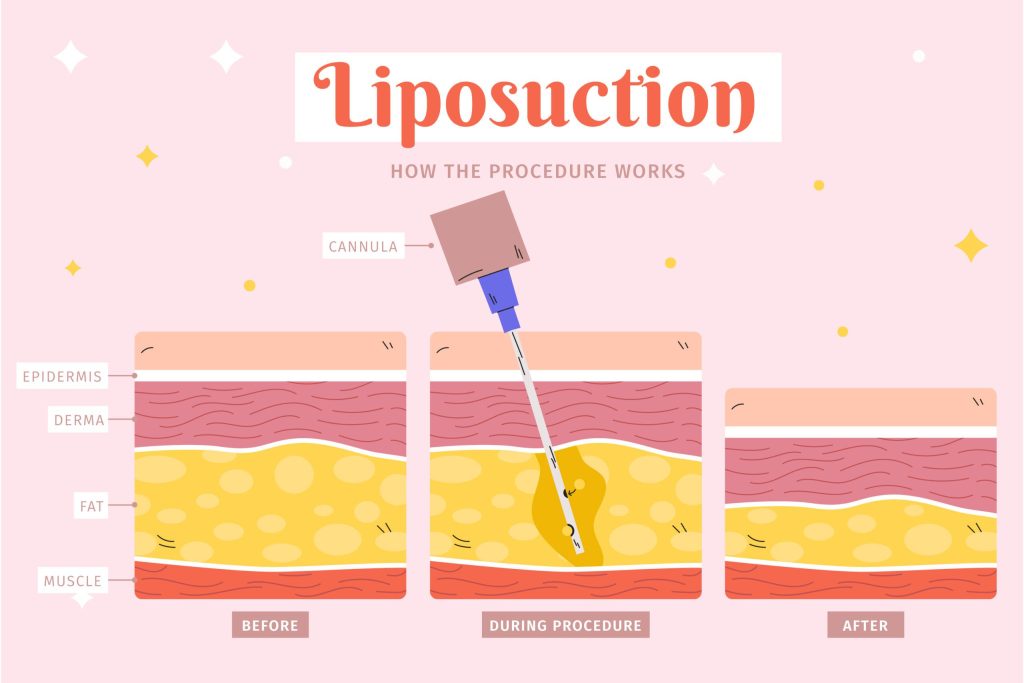 liposuction