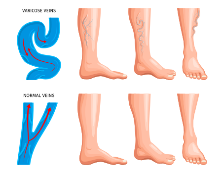 varicose veins anatomy