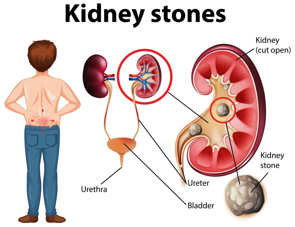 Kidney-Stones