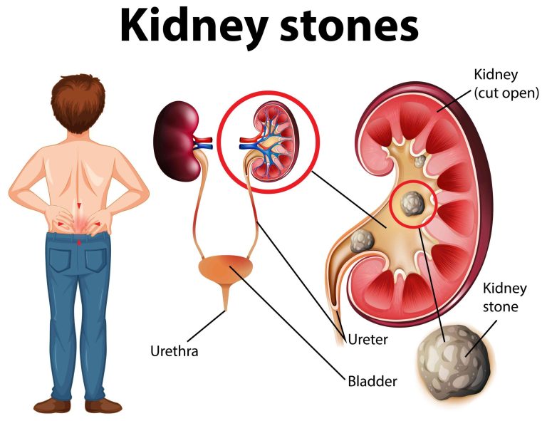 Kidney-Stones