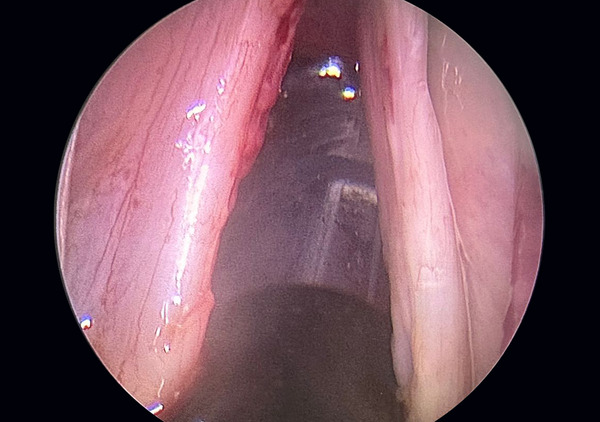 microlaryngeal-excision-of-vocal-cord-immediate-post-op