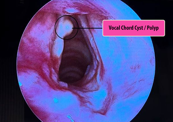 microlaryngeal-excision-of-vocal-cord-pre-op