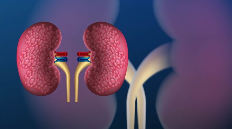 Kidney Stones