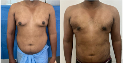 Gynecomastia Correction